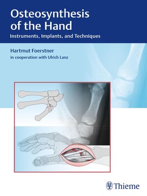 cover image of Osteosynthesis of the Hand